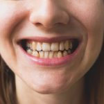 Crooked teeth in the woman's mouth. Dental decay and bad smile. Dentist treatment concept, ozempic teeth side effects