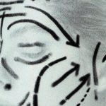 A Deep Plane Facelift at 40: One Woman’s Story