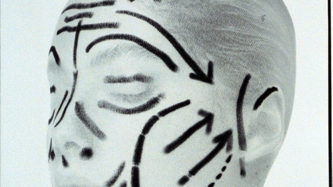 A Deep Plane Facelift at 40: One Woman’s Story