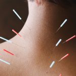 The Benefits of Acupuncture, From Stress Relief to Facial Balancing