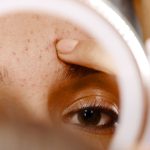 It’s Not a Whitehead, It’s Milia—Here's How to Treat It