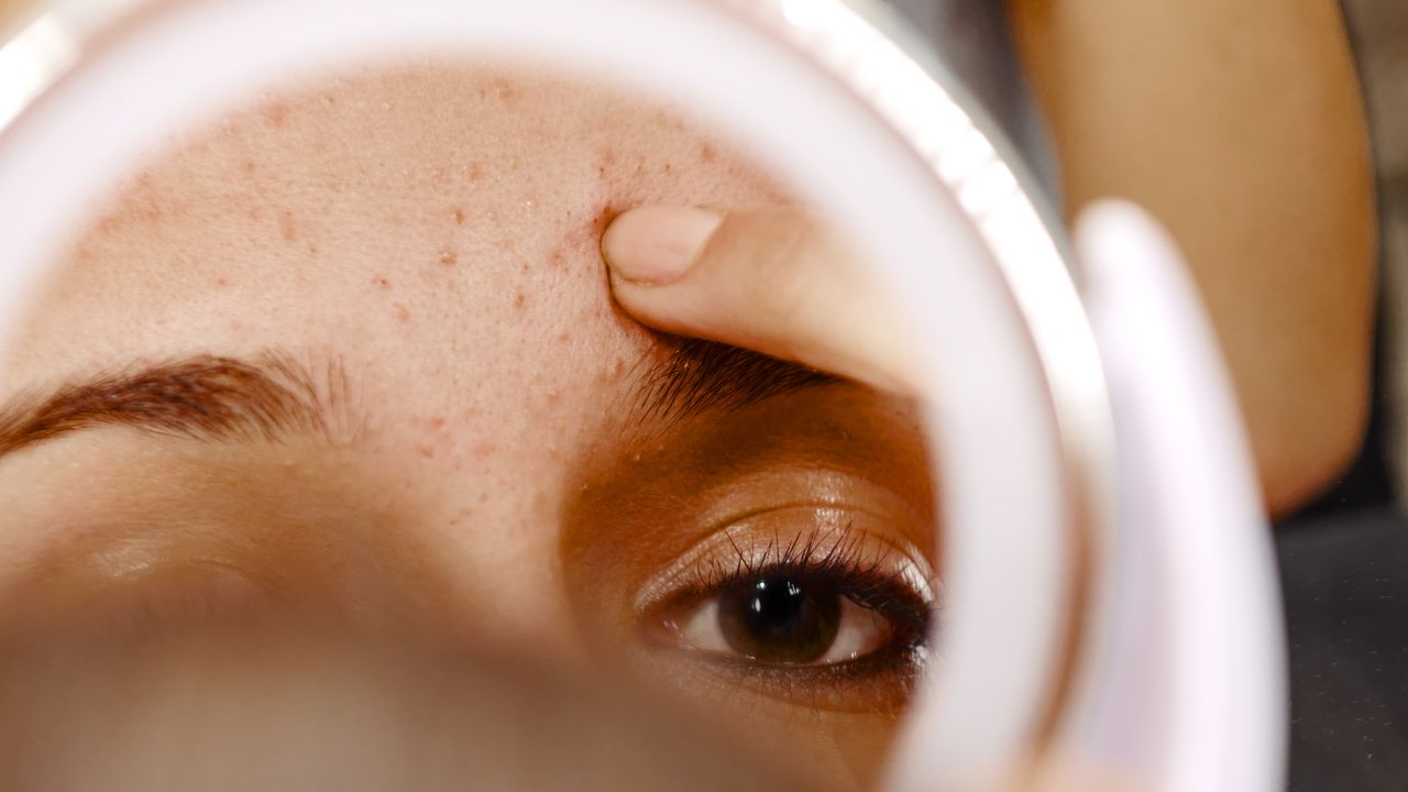 It’s Not a Whitehead, It’s Milia—Here’s How to Treat It